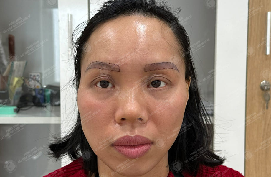 Vũ Thị Hồng - Cấy lông mày 2