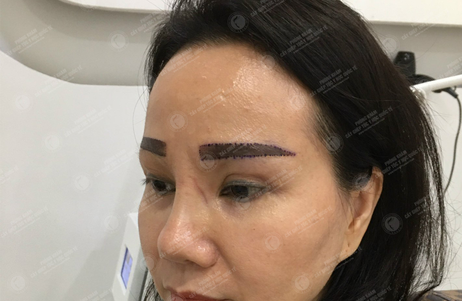 Vũ Ngọc Huyền - Cấy lông mày 3