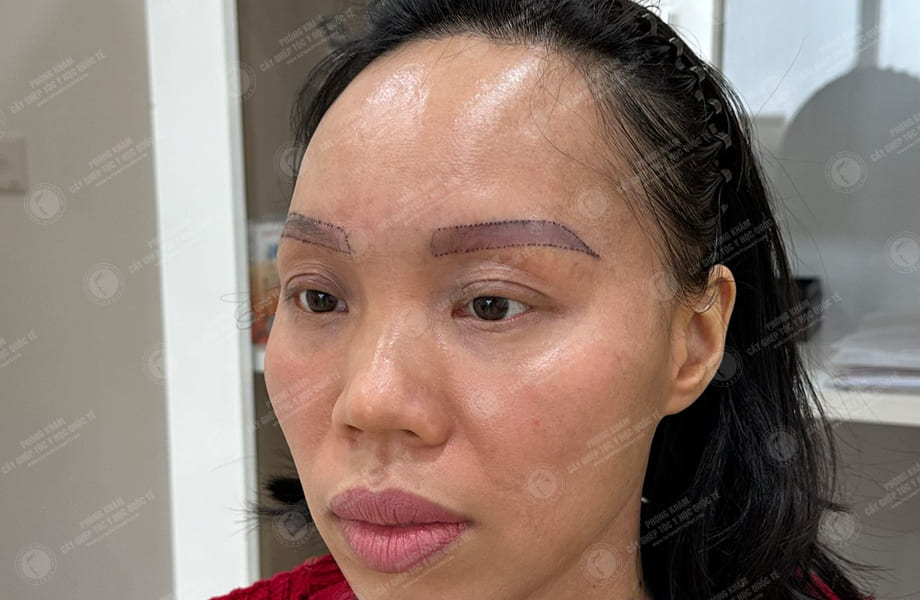 Vũ Thị Hồng - Cấy lông mày 3