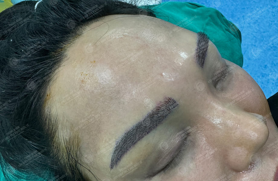 Vũ Thị Hồng - Cấy lông mày 4
