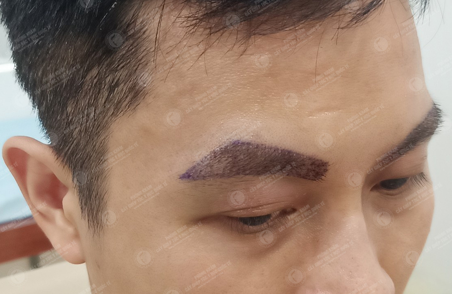 Nguyễn Hoàng Sơn - Cấy lông mày 5