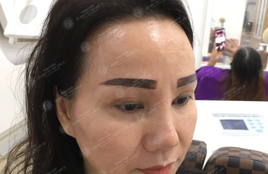 Vũ Ngọc Huyền - Cấy lông mày 4