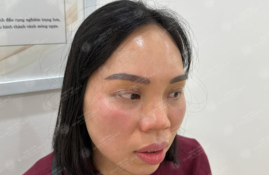 Vũ Thị Hồng - Cấy lông mày 5