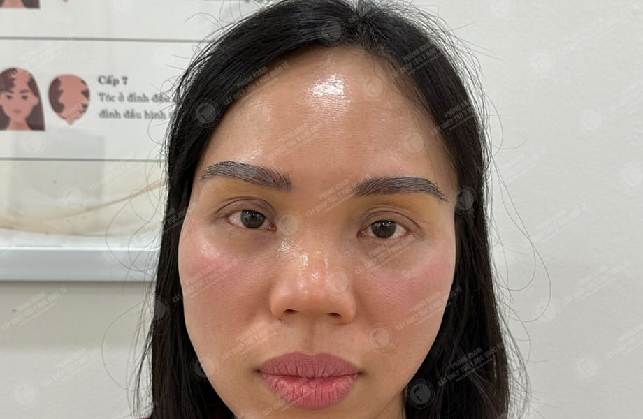 Vũ Thị Hồng - Cấy lông mày 6