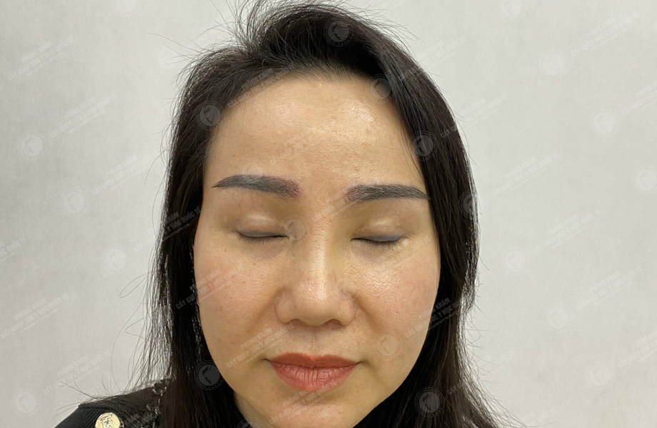 Vũ Ngọc Huyền - Cấy lông mày 6