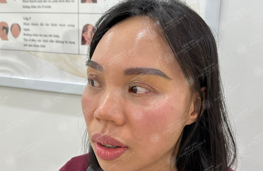 Vũ Thị Hồng - Cấy lông mày 7