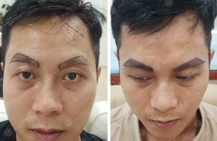  Nguyễn Hoàng Sơn - Cấy lông mày 1