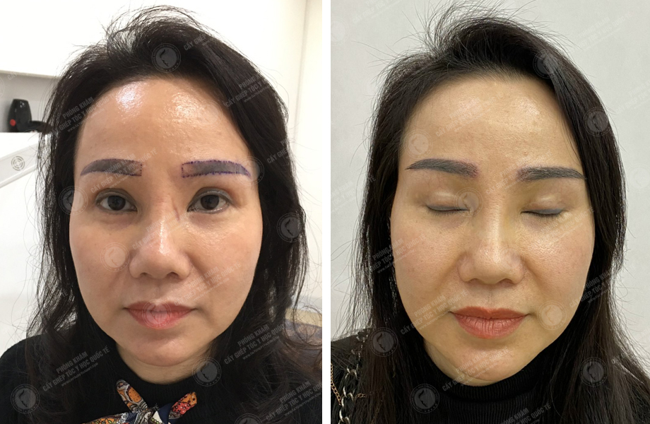  Vũ Ngọc Huyền - Cấy lông mày 1