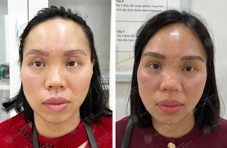  Vũ Thị Hồng - Cấy lông mày 1