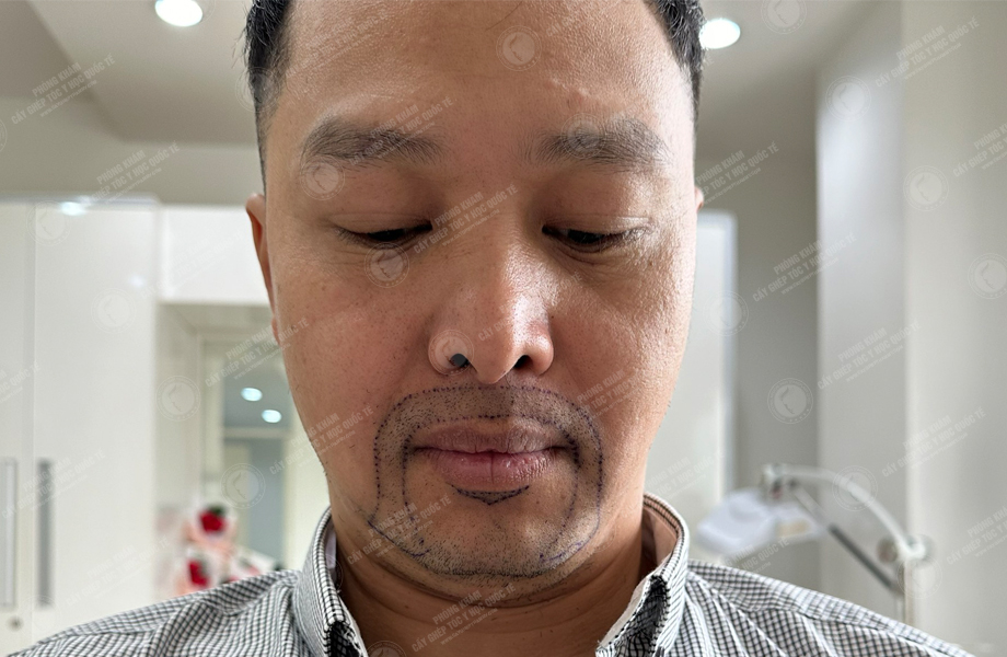 Nguyễn Thành Nhân - Cấy râu 2
