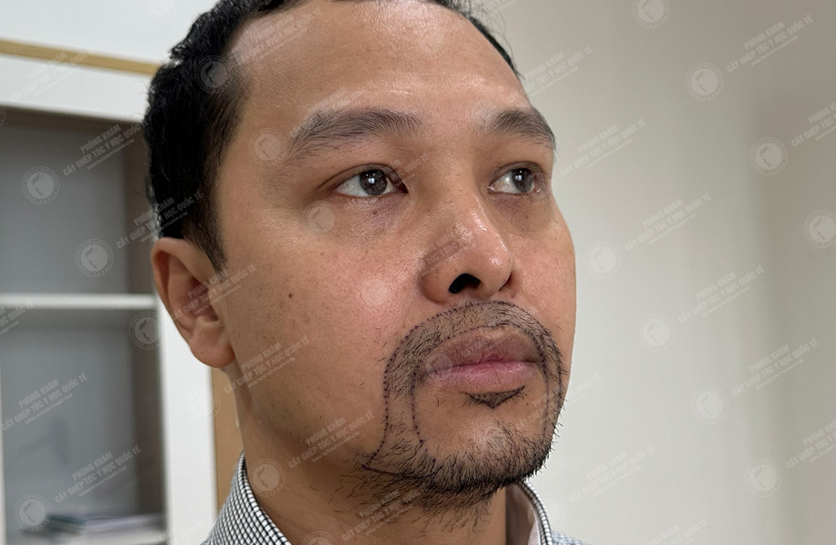 Nguyễn Thành Nhân - Cấy râu 4