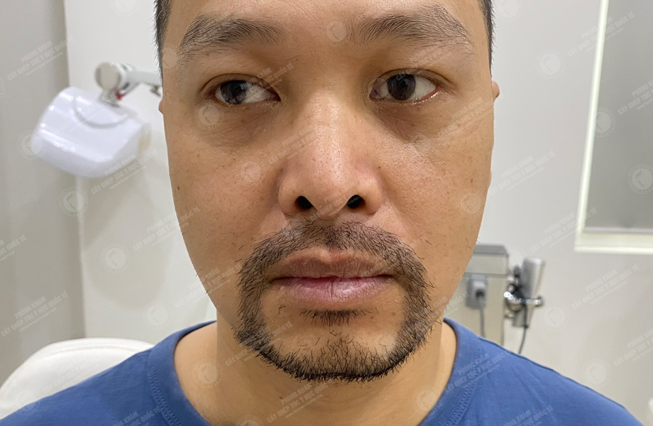 Nguyễn Thành Nhân - Cấy râu 6