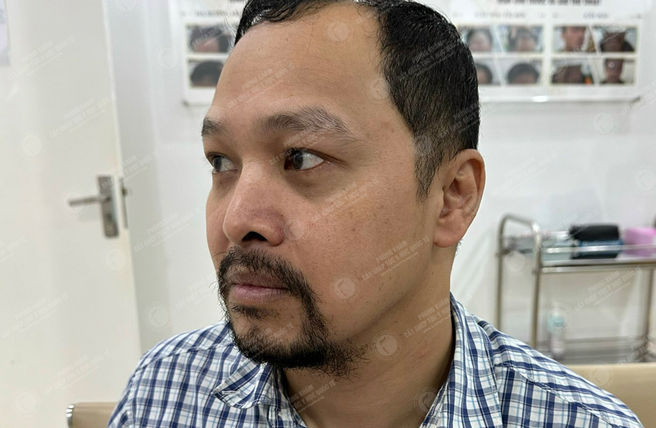 Nguyễn Thành Nhân - Cấy râu 8