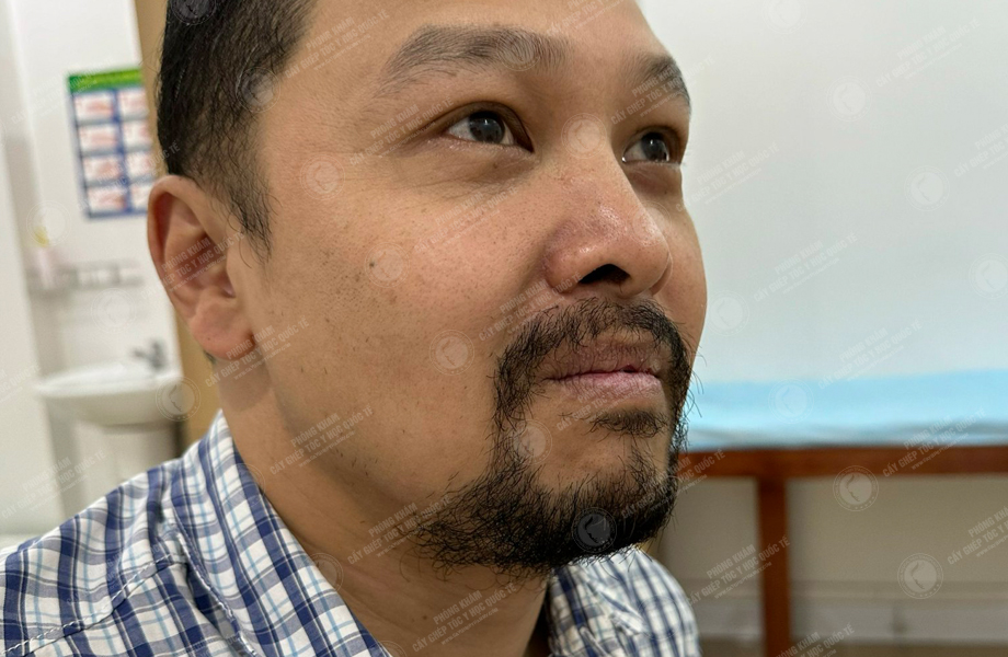 Nguyễn Thành Nhân - Cấy râu 7