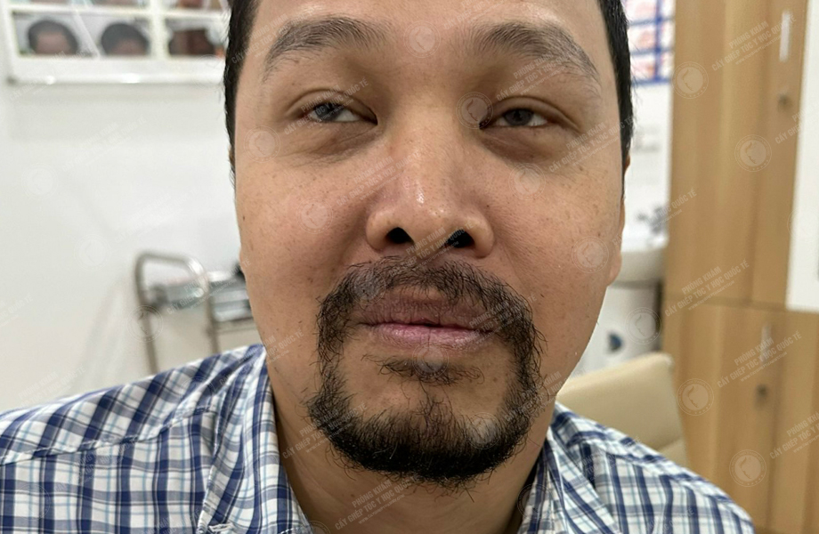Nguyễn Thành Nhân - Cấy râu 9