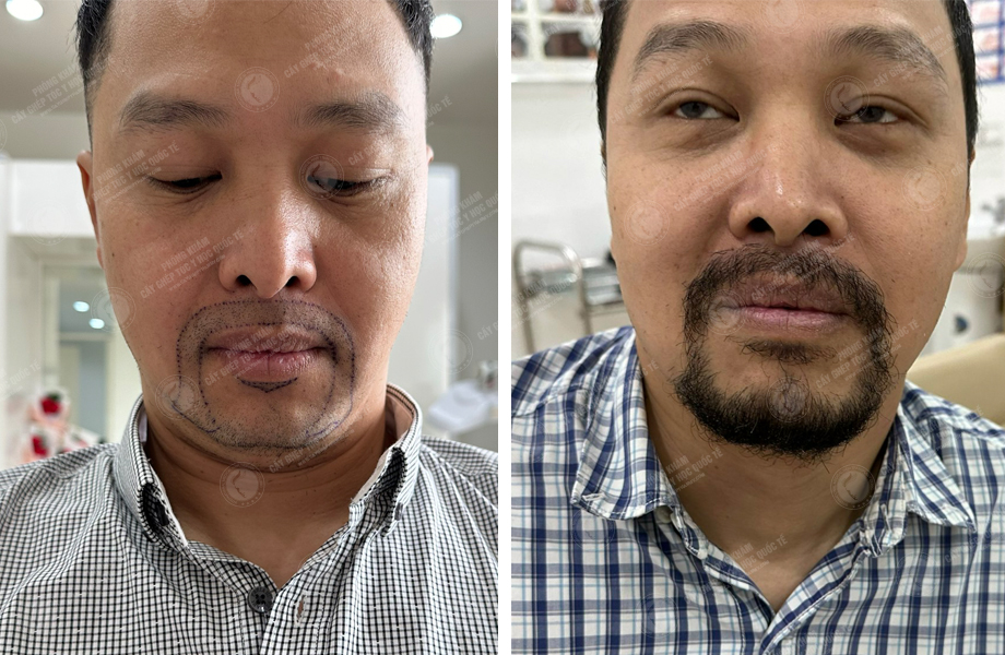  Nguyễn Thành Nhân - Cấy râu 1