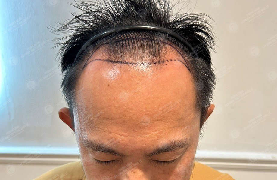 Nguyễn Hữu Huân - Cấy tóc đường chữ M 2