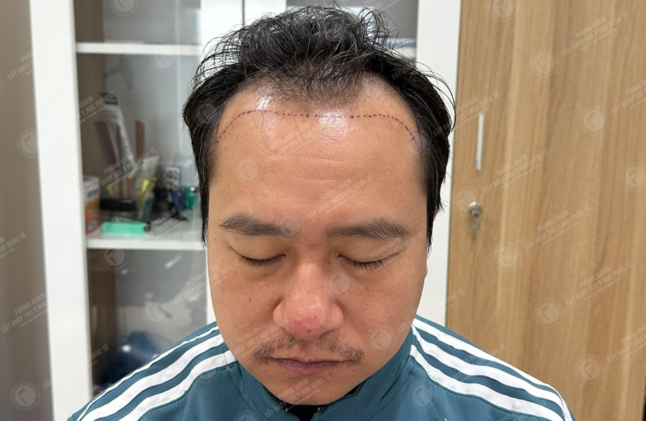 Trần Việt Hoàng - Cấy tóc đường chữ M 2