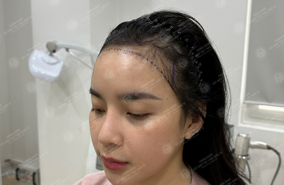 Nguyễn Hoàng Phương - Cấy tóc đường chữ M 2