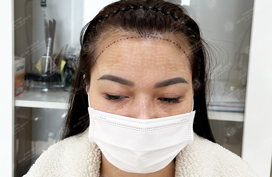 Nguyễn Thi Vân - Cấy tóc đường chữ M 2