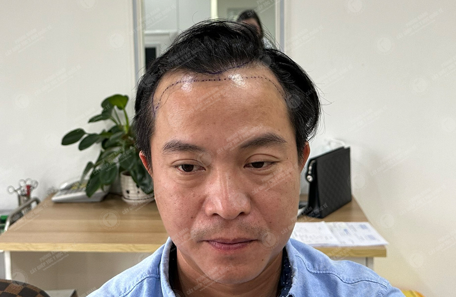 Nguyễn Khoa Tường - Cấy tóc đường chữ M 2