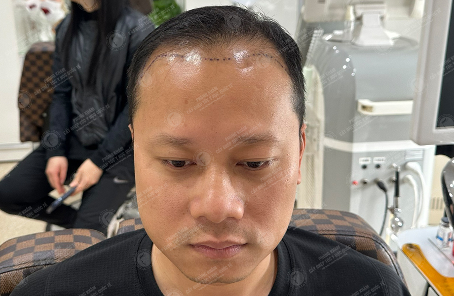 Nguyễn Chí Linh - Cấy tóc đường chữ M 2