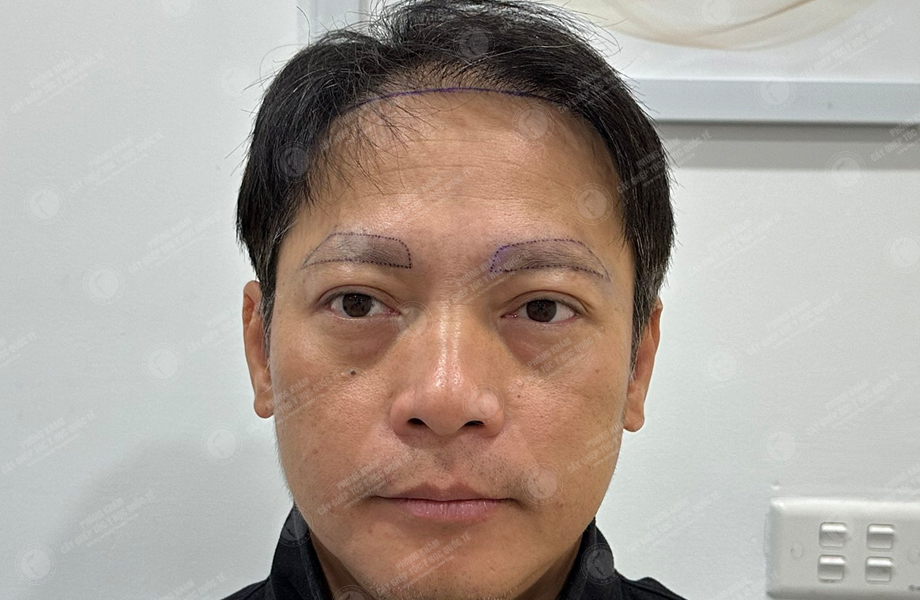 Trần Vinh Sơn - Cấy lông mày 2