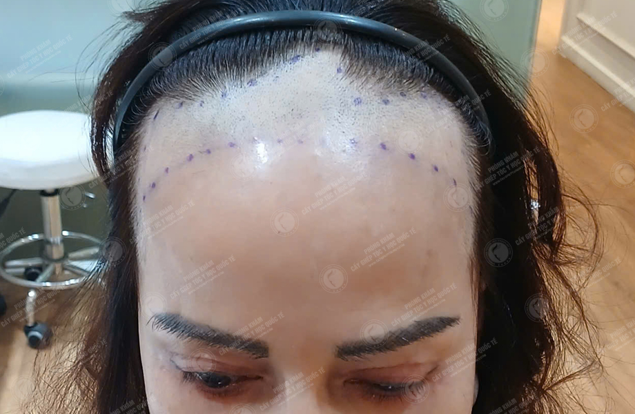 Trịnh Thanh Nga - Cấy tóc tự thân 2