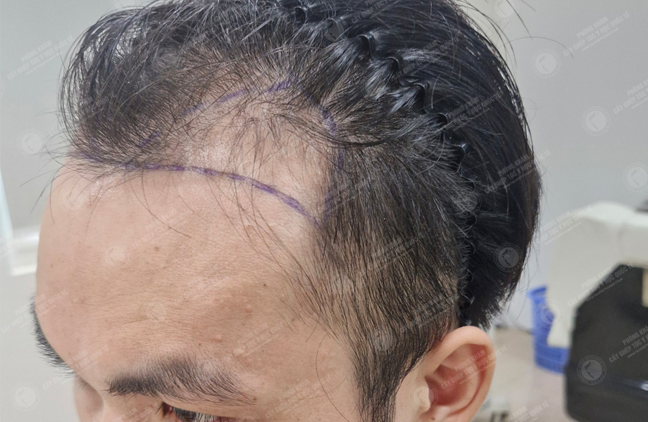 Đỗ Tùng Sang - Cấy tóc đường chữ M 2