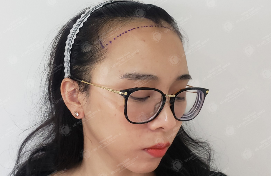 Hoàng Hồng Yến - Cấy tóc đường chữ M 2