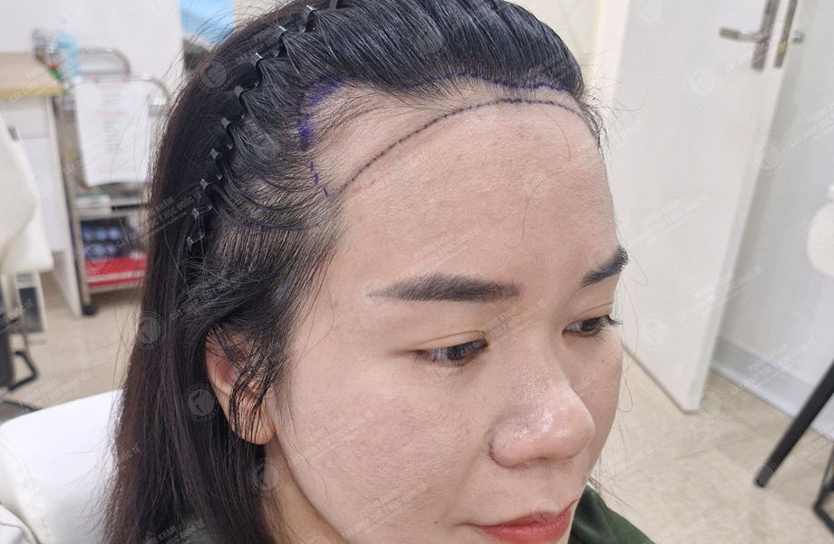 Đinh Thu Hương - Cấy tóc đường chữ M 2