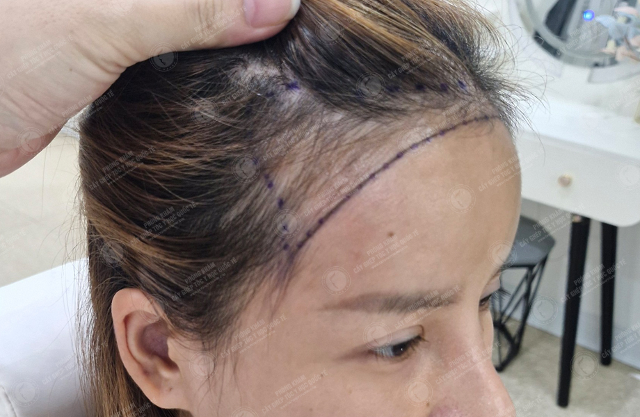 Cù Lệ Quyên - Cấy tóc đường chữ M 2