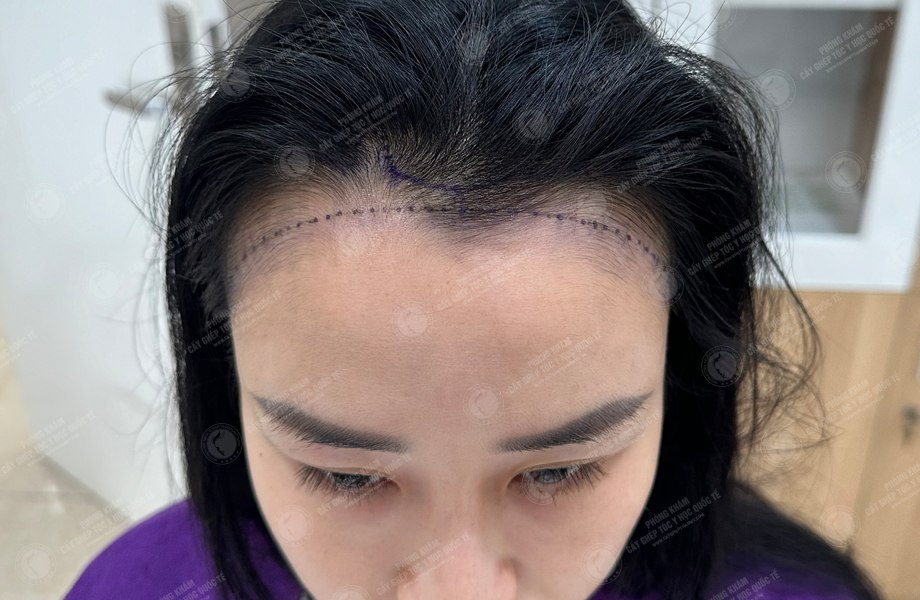 Nguyễn Thanh Hoa - Cấy tóc đường chữ M 2