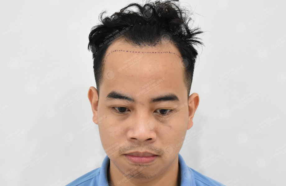 Lý Tùng Thanh - Cấy tóc đường chữ M 2