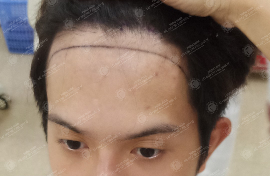 Nguyễn Hoàng Phi - Cấy tóc đường chữ M 2