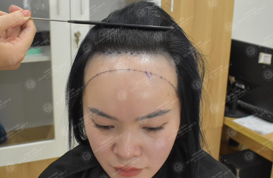 Phạm Thu Huyền - Cấy tóc đường chữ M 2