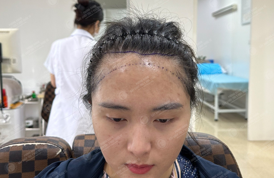 Dư Thu Hoài - Cấy tóc đường chữ M 2