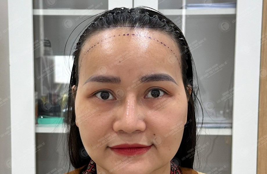Đỗ Thị Thu Trang - Cấy tóc đường chữ M 2