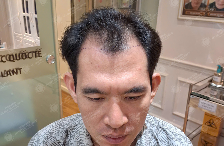 Dương Văn Tiến - Cấy tóc đường chữ M 2