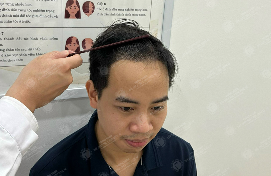 Lý Tùng Thanh - Cấy tóc đường chữ M 11