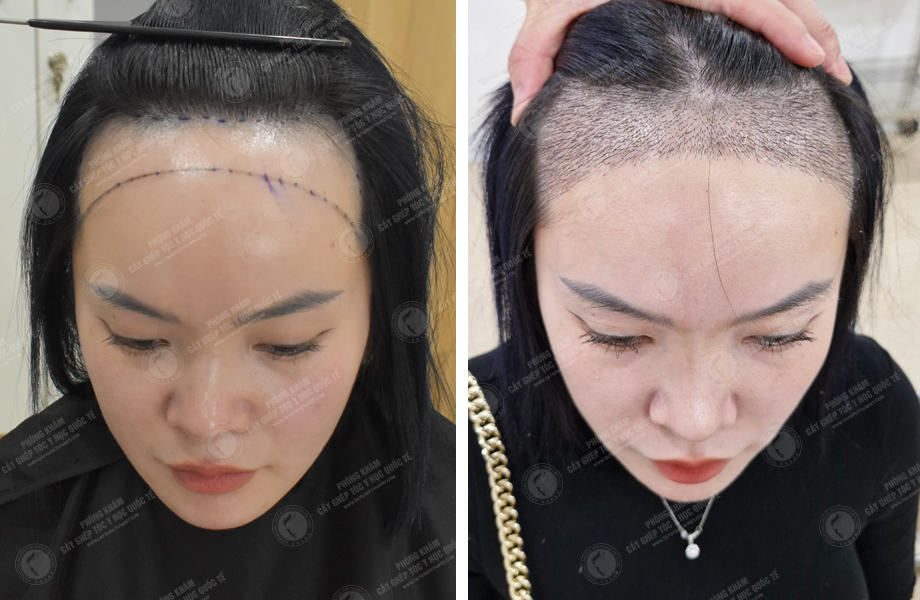  Phạm Thu Huyền - Cấy tóc đường chữ M 1