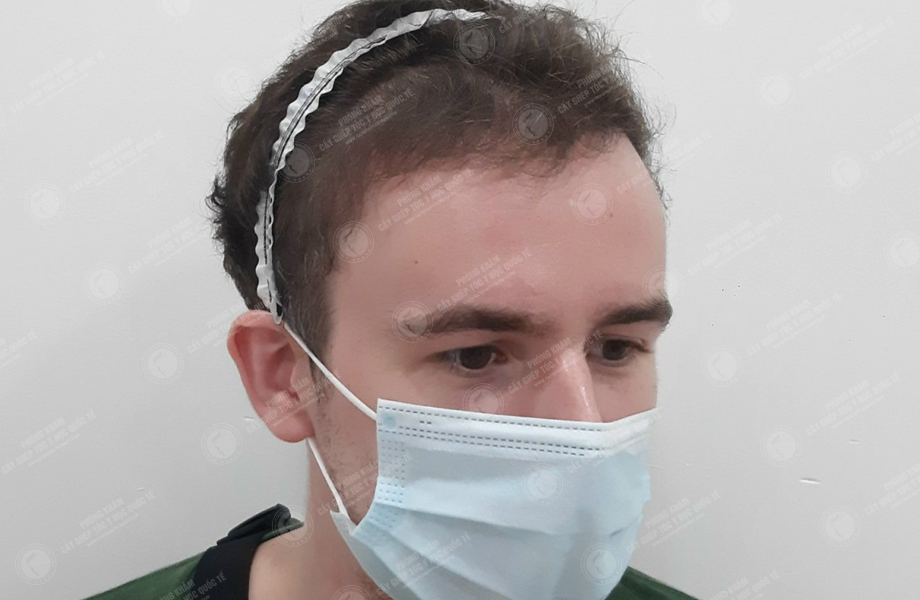 Leo Pary - Cấy tóc đường chữ M 12