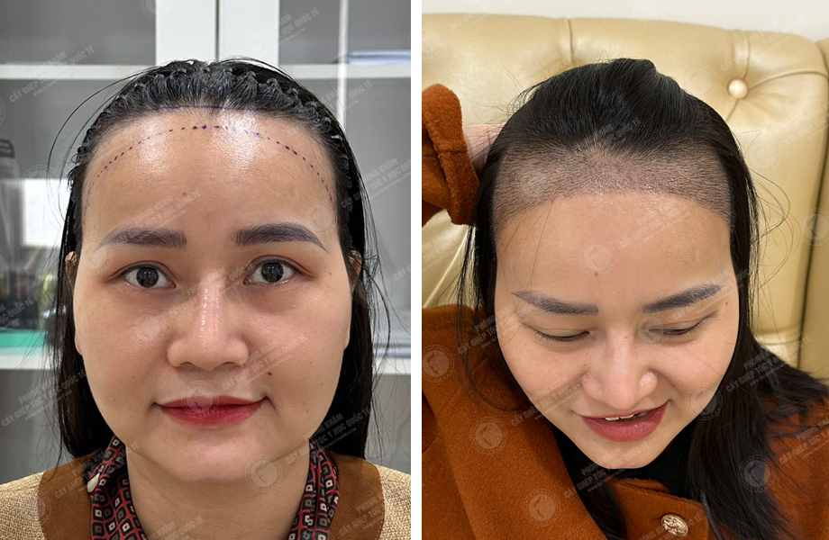  Đỗ Thị Thu Trang - Cấy tóc đường chữ M 1