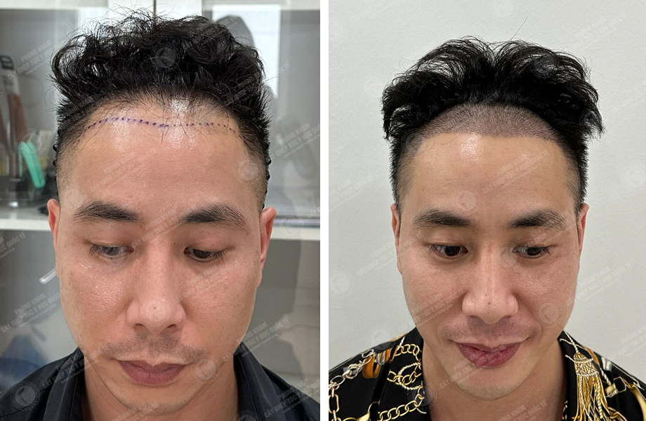  Hoàng Anh Tài - Cấy tóc đường chữ M 1
