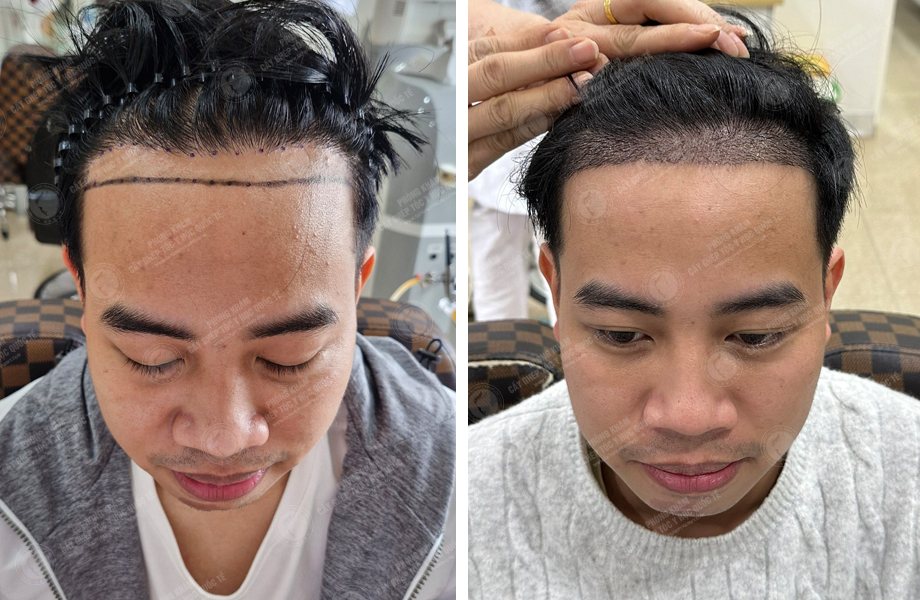  Lã Duy Thanh - Cấy tóc đường chữ M 1