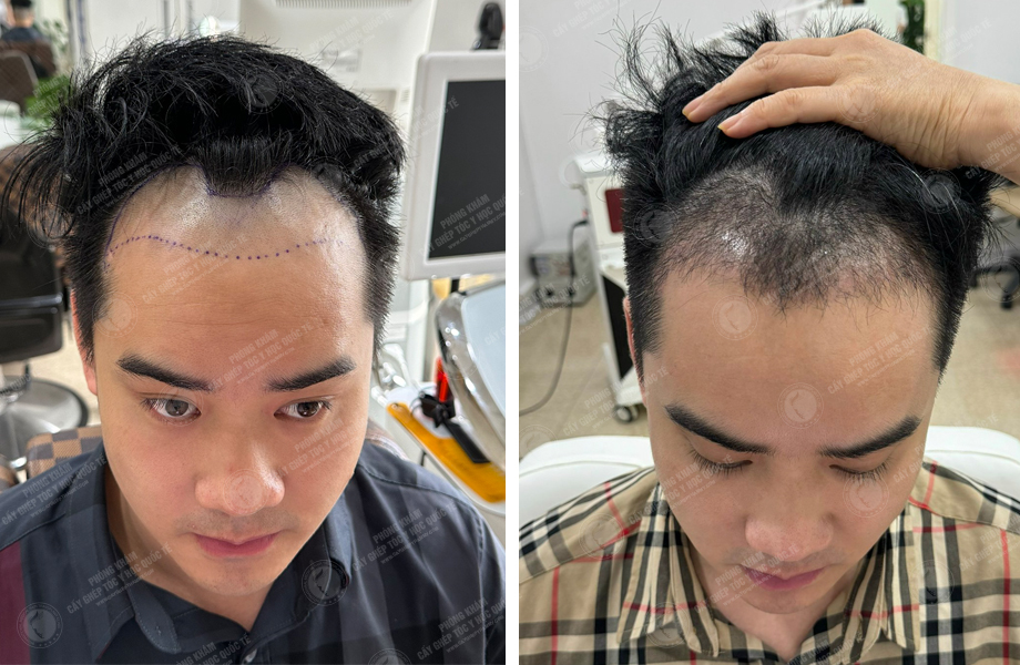  Vi Văn Tam - Cấy tóc đường chữ M 1