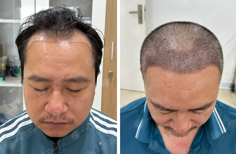  Trần Việt Hoàng - Cấy tóc đường chữ M 1