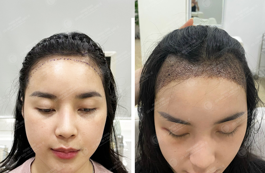  Nguyễn Hoàng Phương - Cấy tóc đường chữ M 1