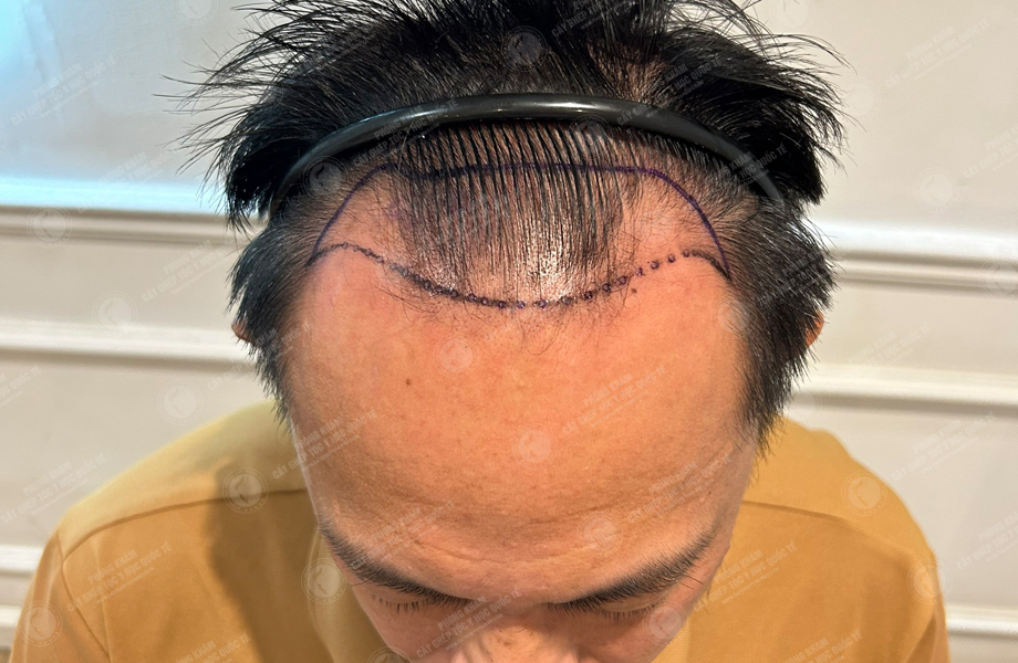 Nguyễn Hữu Huân - Cấy tóc đường chữ M 3