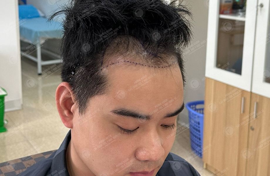 Vi Văn Tam - Cấy tóc đường chữ M 3